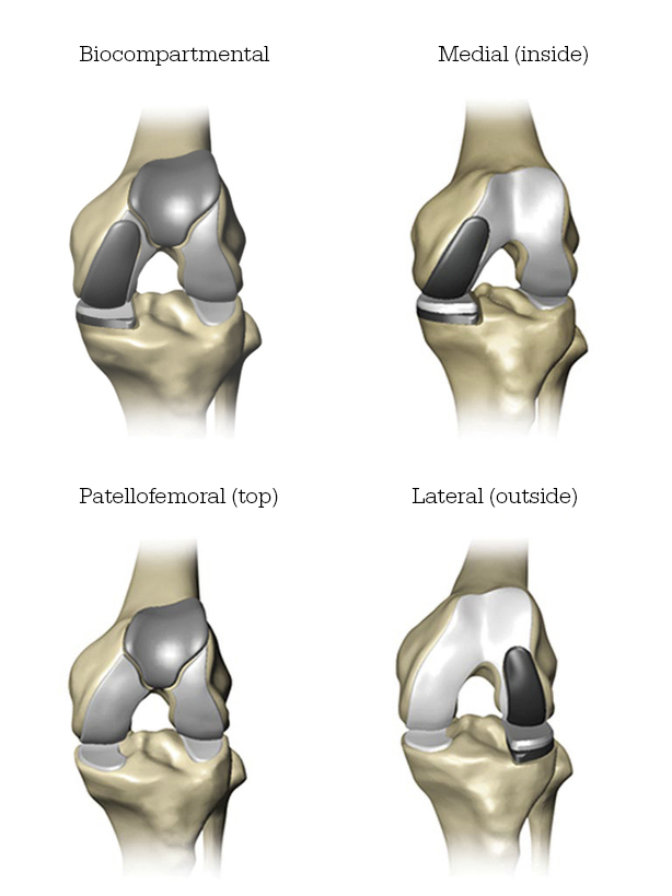 Partial knee replacement illustration