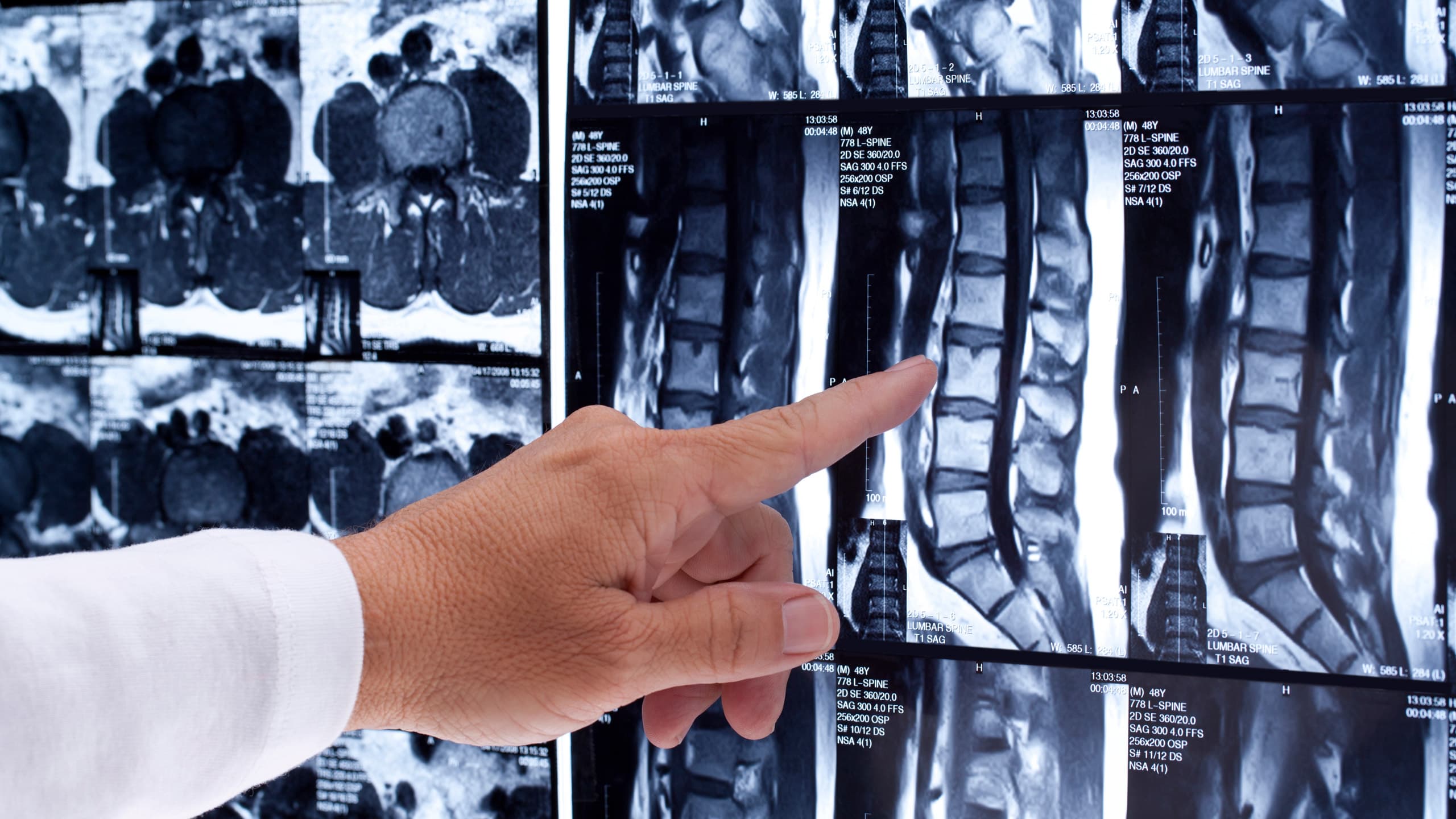 Close-up of an orthopedic doctor participating in clinical research, pointing at wall of MRI scans of lumbar spine